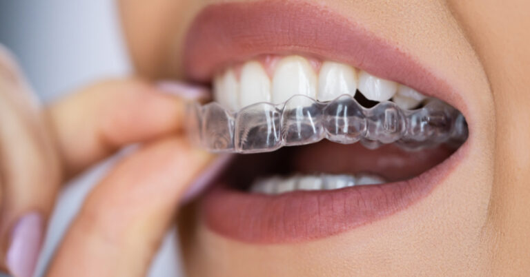 invisalign em cotia